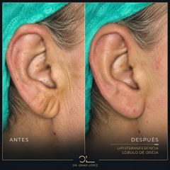 Clínica Dr. Omar López - Lipofilling