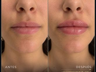 Lipofilling antes y después - 881252