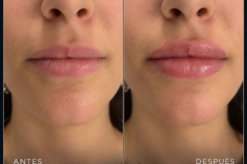 Lipofilling antes y después - 881252