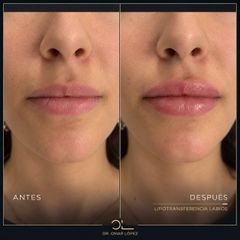 Clínica Dr. Omar López - Lipofilling