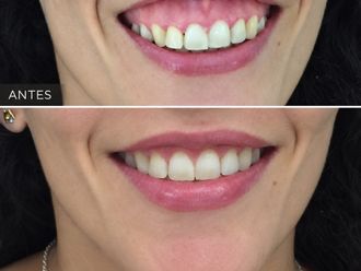 Rejuvenecimiento facial antes y después - 881253