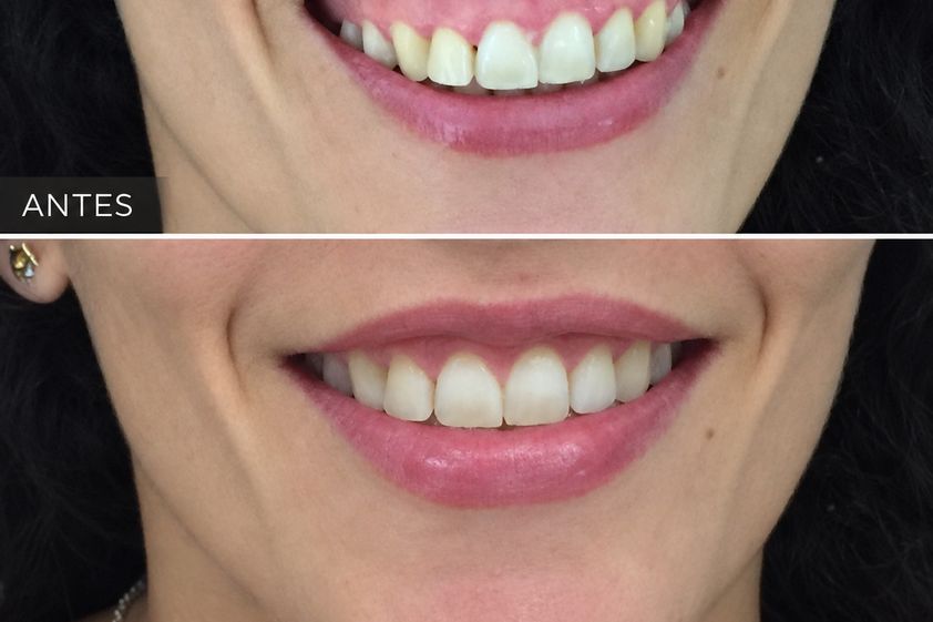 Rejuvenecimiento facial antes y después - 881253