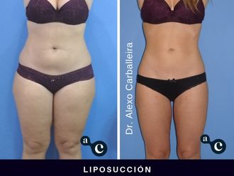 Liposucción - 637716