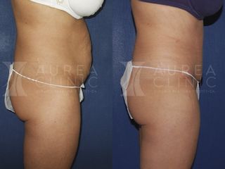 Antes y después Abdominoplastia