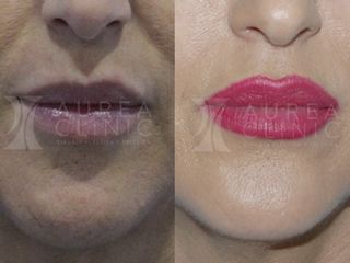 Antes y después Aumento de labios con Ácido Hialurónico