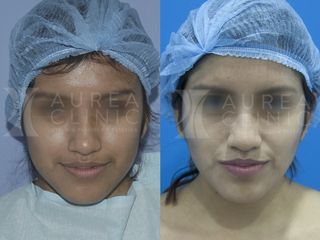 Antes y después Bichectomía (reducción de mejillas)