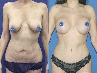 Antes y después Abodminoplastia y mastopexia con prótesis