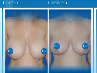 Antes y después Reducción de senos