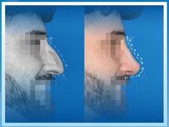 Rinoplastia - 641479