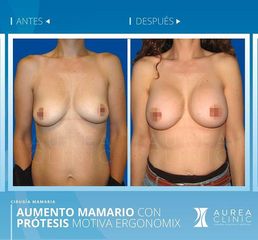 Antes y después Aumento de pecho - Dra. Ana Martinez Padilla