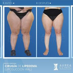 Antes y después Liposucción - Dra. Ana Martinez Padilla