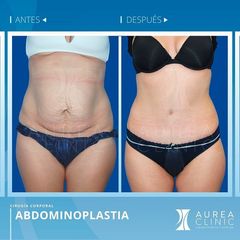 Antes y después Abdominoplastia - Dra. Ana Martinez Padilla
