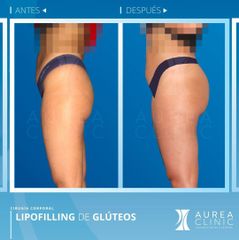 Antes y después Lipofilling de glúteos - Dra. Ana Martinez Padilla