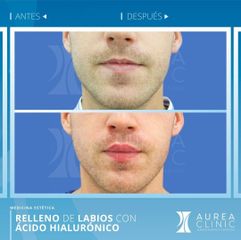 Antes y después Aumento de labios - Dra. Ana Martinez Padilla
