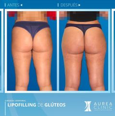 Antes y después Lipofilling de glúteos - Dra. Ana Martinez Padilla