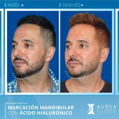 Antes y después Ácido hialurónico - Dra. Ana Martinez Padilla