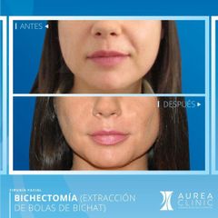 Antes y después Bichectomía - Dra. Ana Martinez Padilla