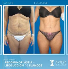 Antes y después Abdominoplastia - Dra. Ana Martinez Padilla