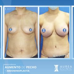 Aumento de Pecho y Abdominoplastia - Dra. Ana Martinez Padilla