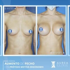 Aumento de Pecho - Dra. Ana Martinez Padilla