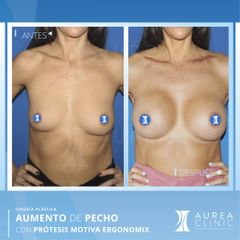 Aumento de Pecho - Dra. Ana Martinez Padilla