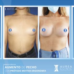 Aumento de Pecho - Dra. Ana Martinez Padilla
