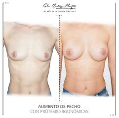 AUMENTO DE PECHO - DRA. ANA MARTINEZ PADILLA