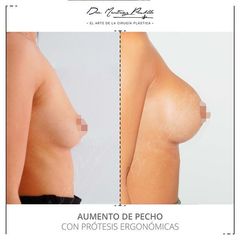 AUMENTO DE PECHO - DRA. ANA MARTINEZ PADILLA