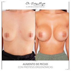 AUMENTO DE PECHO - DRA. ANA MARTINEZ PADILLA
