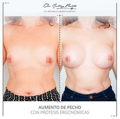 AUMENTO DE PECHO - DRA. ANA MARTINEZ PADILLA