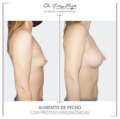 AUMENTO DE PECHO - DRA. ANA MARTINEZ PADILLA