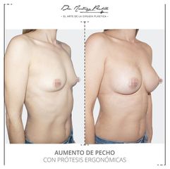 AUMENTO DE PECHO - DRA. ANA MARTINEZ PADILLA