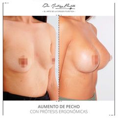 AUMENTO DE PECHO - DRA. ANA MARTINEZ PADILLA