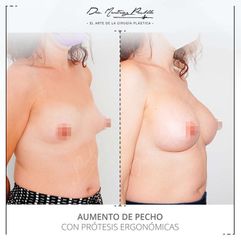 AUMENTO DE PECHO - DRA. ANA MARTINEZ PADILLA
