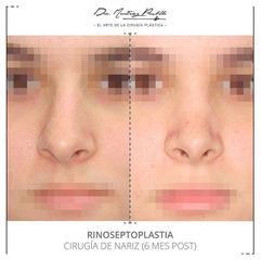 Rinoseptoplastia - Dra. Ana Martinez Padilla
