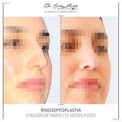 Rinoseptoplastia - Dra. Ana Martinez Padilla