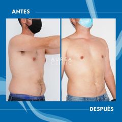 Liposucción - Dra. Ana Martinez Padilla