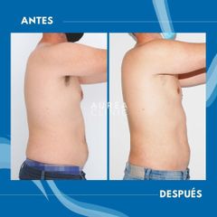 Liposucción - Dra. Ana Martinez Padilla