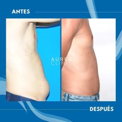 Liposucción - Dra. Ana Martinez Padilla