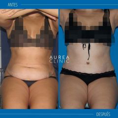 Liposucción - Dra. Ana Martinez Padilla