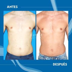 Liposucción - Dra. Ana Martinez Padilla
