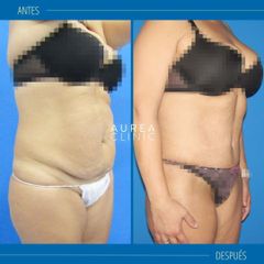 Liposucción - Dra. Ana Martinez Padilla