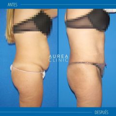 Liposucción - Dra. Ana Martinez Padilla