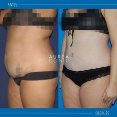 Liposucción - Dra. Ana Martinez Padilla