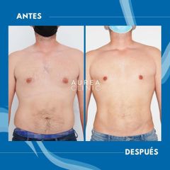 Liposucción - Dra. Ana Martinez Padilla