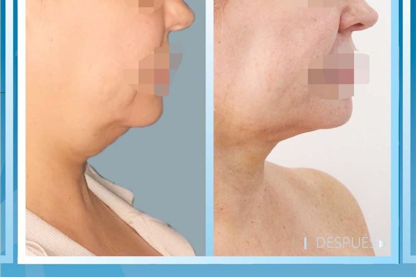 Liposucción de papada antes y después - 820777