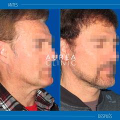 Lifting cervicofacial