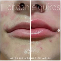 Aumento de labios - Dr Daniel Quirós