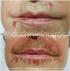 Eliminación de arrugas con Plexr - Dr Daniel Quirós