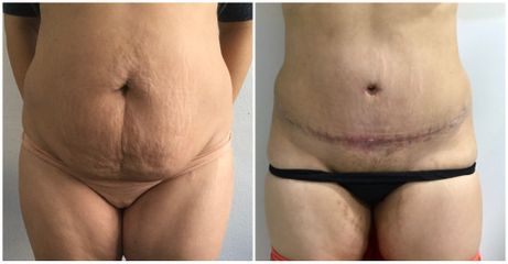 Abdominoplastia - Dr. Albert Vizmanos